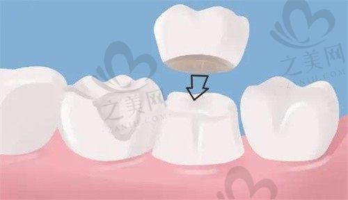 根管治疗后多久做牙冠比较好?牙冠真的有必要吗