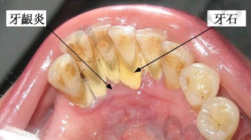 牙石导致牙龈炎