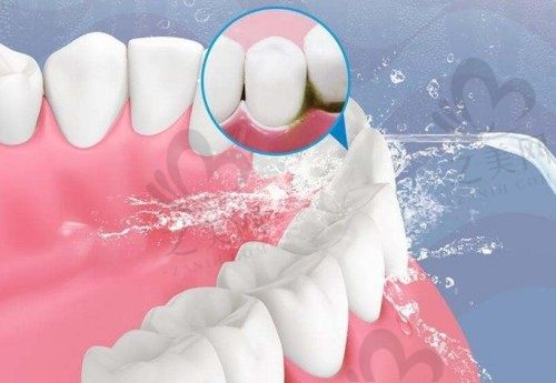 洗牙后牙缝能否恢复