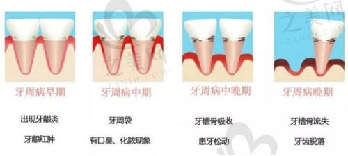 坐月子不刷牙的后果