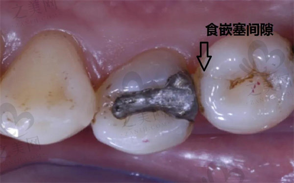 食物嵌塞牙齿间隙对比图