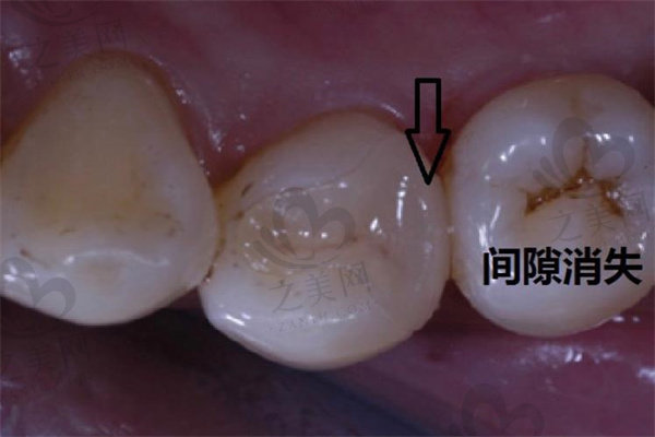 食物嵌塞牙齿间隙对比图