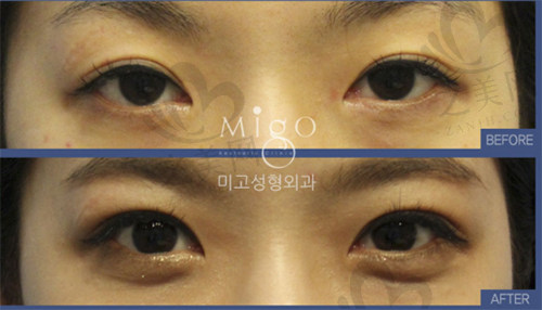 韩国大眼睛整形外科医院术后分享