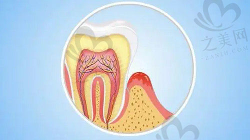 牙周病原因