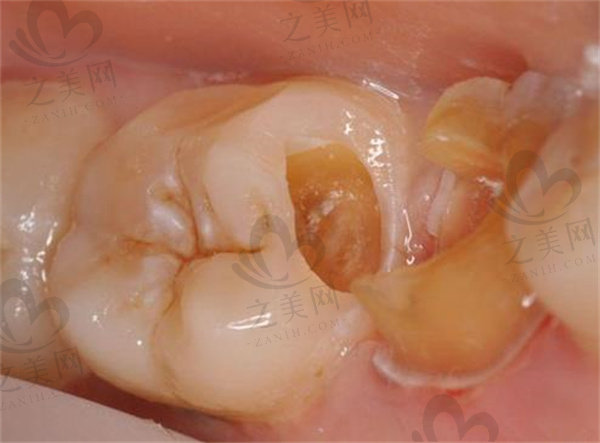 牙髓炎图片