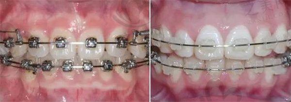 各类牙齿矫治器