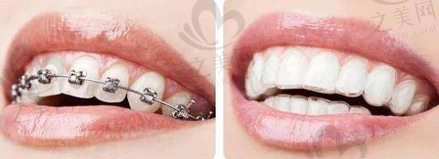 各类牙齿矫治器