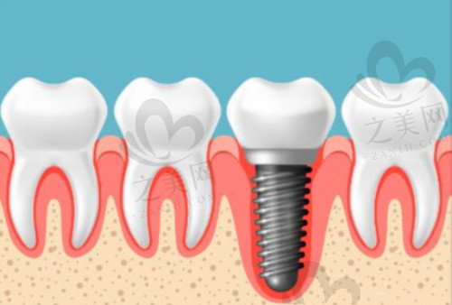 种植牙价格跟什么有关