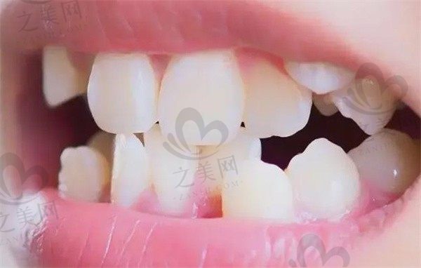 牙齿不齐一定要矫正吗?对后代有什么影响,又该怎么调整呢?
