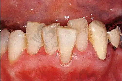 牙周炎定义