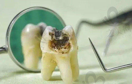 牙髓炎定义