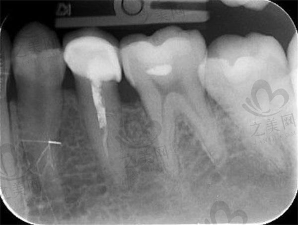 牙齿根管治疗填充失败牙片