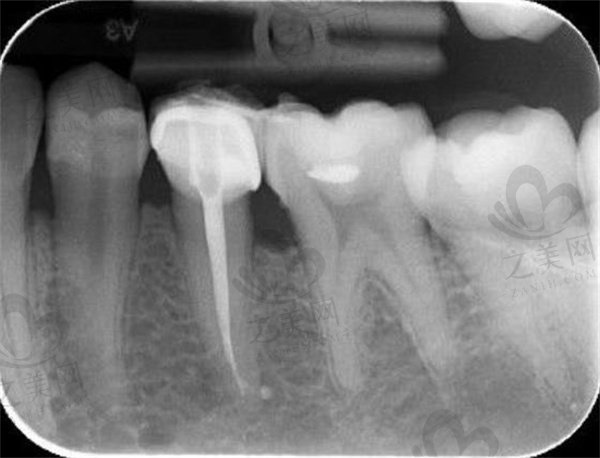 牙齿根管再治疗填充牙片