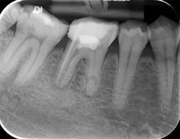 牙齿根管治疗填充失败牙片