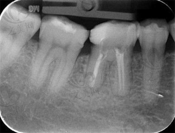牙齿根管再治疗填充牙片