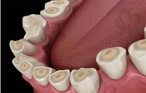 磨牙会使牙齿凹槽消失