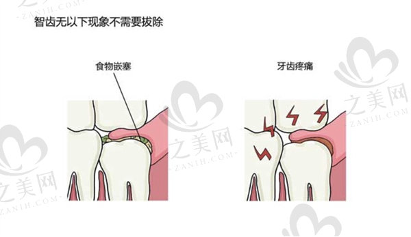 不用拔除的智齿