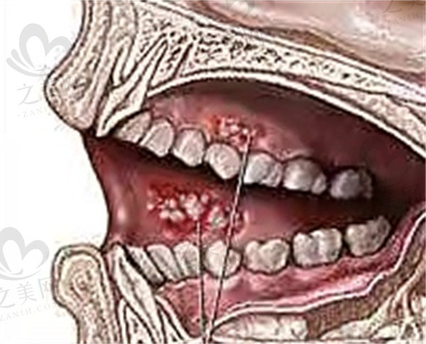 牙龈癌2