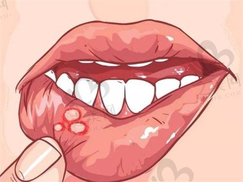 口腔溃疡是什么原因造成的?反复发作怎么治