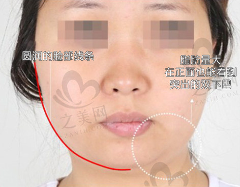 TS面部吸脂（脸颊下巴吸脂）的真实例子
