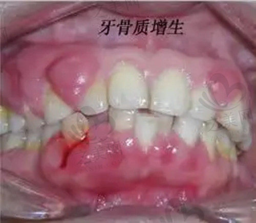 牙骨质增生