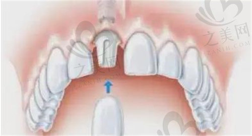 牙周基础不好的患者更适合种植镶牙修复