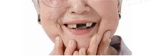 戴牙套老了以后牙齿就早早掉了吗?牙套让牙根松动是真的假的