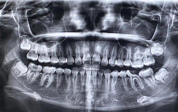 做牙齿ct后多久可以怀孕?对人体有什么危害?