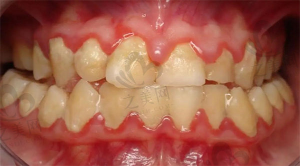 牙龈肿胀图片