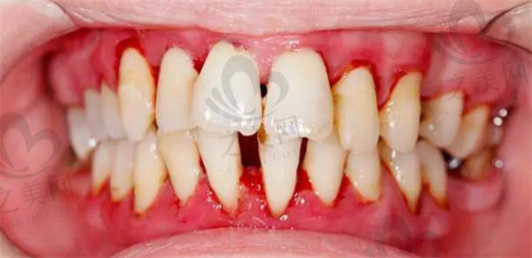 牙龈肿胀图片