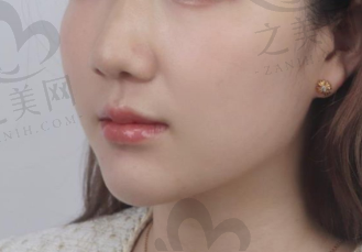 徐赤宇下巴填充.png