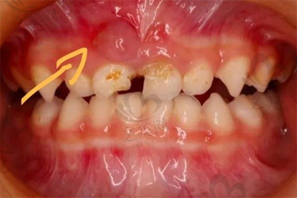 牙龈肿了个肉坨怎么办?不痛可以自愈吗?