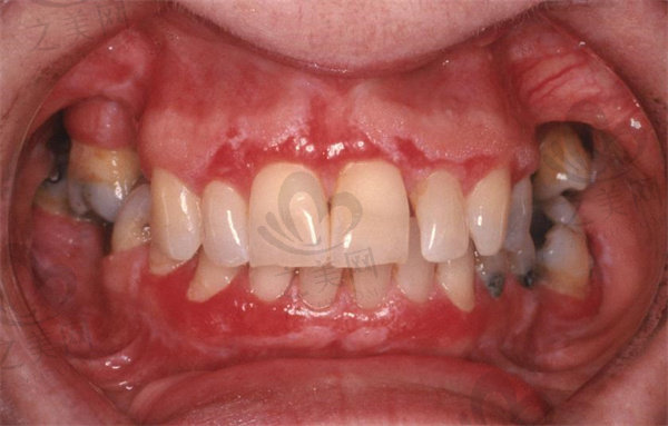 牙科病症图片