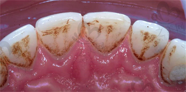 牙釉质受损图片