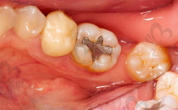牙科疗治图片