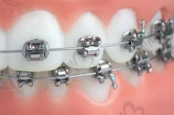 金属托槽牙齿矫治器模型