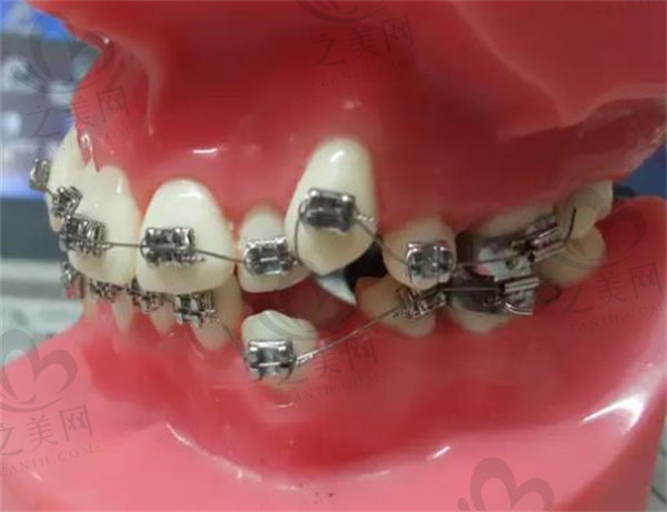 金属托槽牙齿矫治器模型