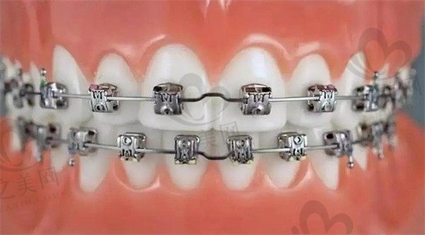 金属自锁托槽掉了一颗怎么办?能再重新粘上吗?