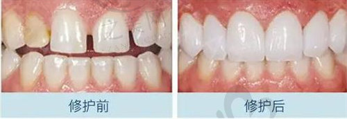 牙缝大通过牙贴面修复后变化