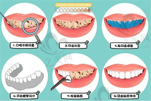 牙贴面修复过程