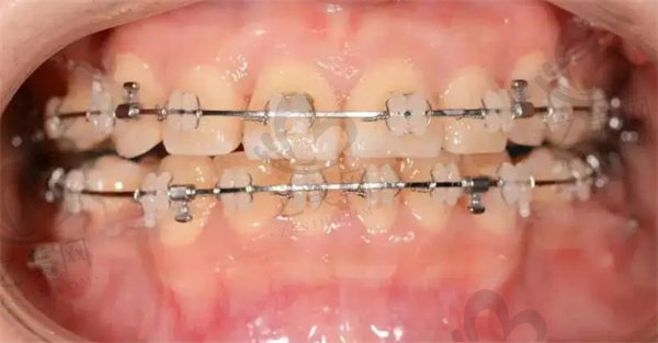 陶瓷半隐形牙齿矫治器图片