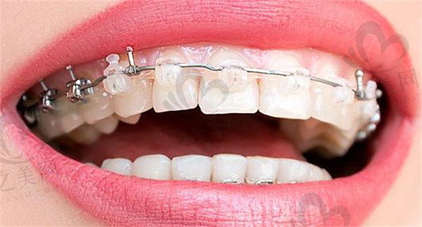 冰晶半隐形牙齿矫治器图片