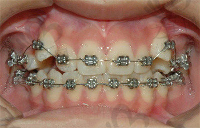 刘保民医生在牙齿矫正方面的技术优势