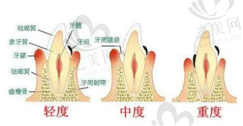 漱口水和盐水