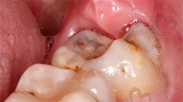 做根管治疗和拔智齿可以同时进行吗?需要多久?