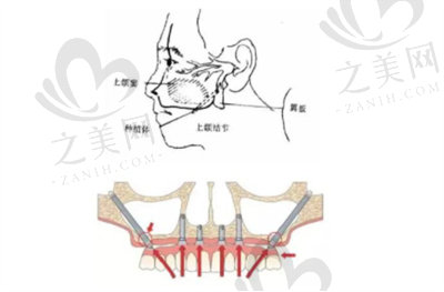 吴晓飞医生在穿颧穿翼种植手术方面的技术优势