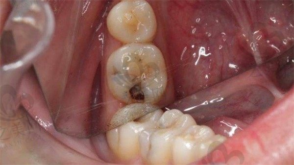 补牙后牙疼怎么缓解疼痛?需要把补的东西取出来吗?