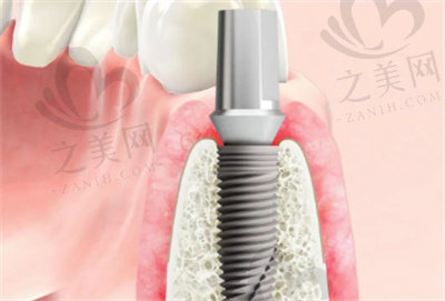 郑园娜医生在种植牙方面的技术优势