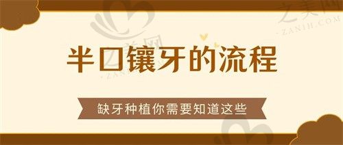 半口镶牙需要的流程有什么?听专科医生回答种植过程