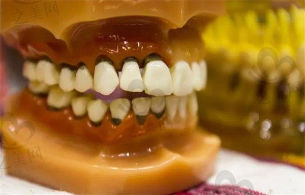 牙齿出现黑色污垢,一按就疼怎么回事儿?该咋去除?